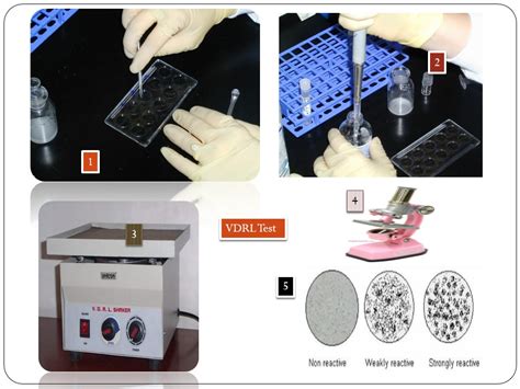 VDRL Test: Principle, Procedure, Results • Microbe .